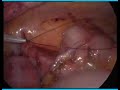 laparoscopic appendectomy laparoscopic appendectomy