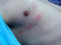 Dextrocardia, unique ventricle, pectus excavatum Dextrocardia, unique ventricle, pectus excavatum
