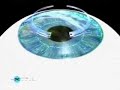 Dr. Boxer Wachler Uses Intacs to Improve Eyesight Dr. Boxer Wachler Uses Intacs to Improve Eyesight