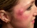 Girl popping massive zit