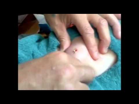 zit - http://www.pimpletube.com A collection of the best blackhead popping videos that can be found on www.pimpletube.com, a video site dedicated to pimple, zit an...