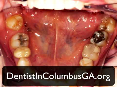 how to cure oral cancer