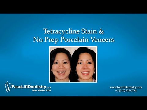 how to whiten teeth stained by tetracycline
