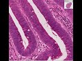 Histopathology Colon--Tubular adenoma Histopathology Colon--Tubular adenoma
