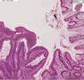 Histopathology Colon--Tubular adenoma