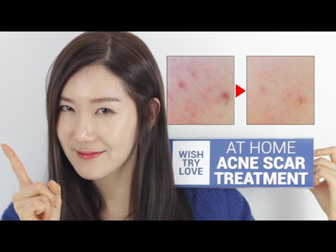 how to get rid of acne scars at home