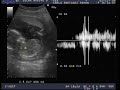18 semanas.avi