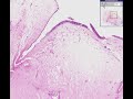 Histopathology Nose --Nasal polyp Histopathology Nose --Nasal polyp
