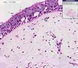Histopathology Nose --Nasal polyp