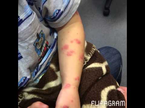 how to treat erythema multiforme