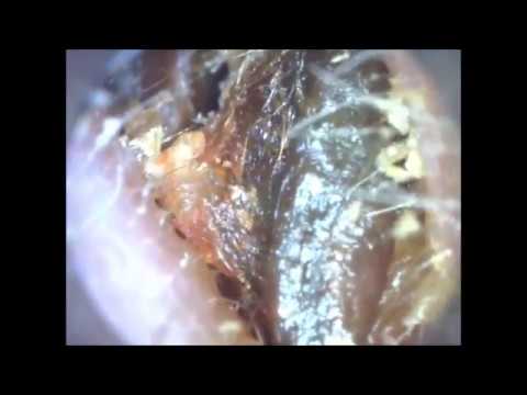how to unclog impacted ear wax