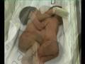 Conjoined twins update.