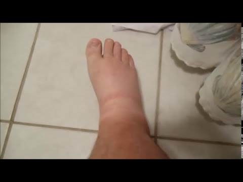 how to relieve edema