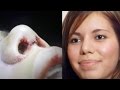 Cosmetic Surgery Documentary - Ethnic Nose Job - Plastic Surgeon Beverly Hills