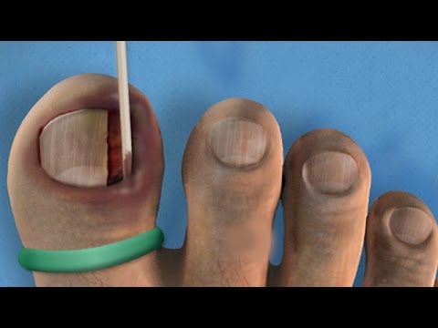 how to get rid ingrown toenail infection