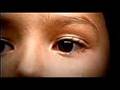 Retinoblastoma