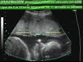 GRAVIMAGEM 913 (ULTRA-SOM 3D 4D GRAVIDEZ  COM 29 SEMANAS)