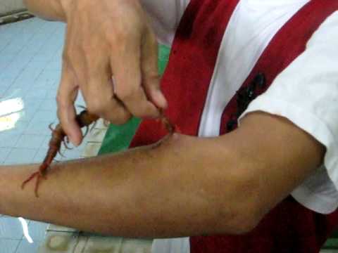 how to cure centipede bite