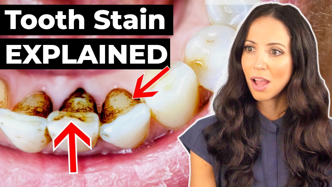 Can Fluoride Cause Teeth Discoloration? (Explained) Fluoride Action