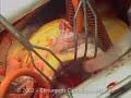 Mitral repair / Dr Vigneron ( clinique Tonkin)