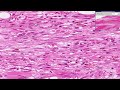 Histopathology Heart --Myocardial infarction, recent