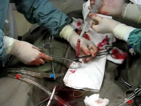 Connect removal cannula to ECMO.avi