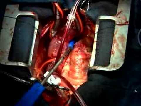how to transplant a human heart