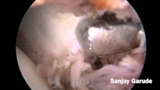 Arthroscopic Latarjet