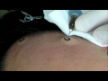 steatocystoma multiplex脂腺嚢腫除去