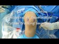 MPFL Correction In Kneecup Displacement