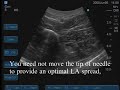 Ultrasound-Guided Anterior Sciatic Nerve Block Ultrasound-Guided Anterior Sciatic Nerve Block