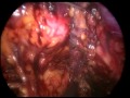 Tension-Free Vaginal Tape (TVT) - Total Laparoscopic Excision