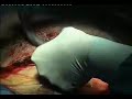 Cesarean section in Milano Cesarean section in Milano