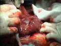 Cesarean section in Milano