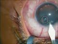 Bilateral Simaltanous Cataract extraction