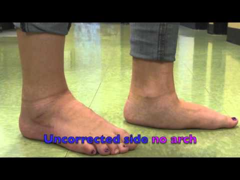 how to cure flat feet