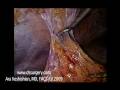 Abdominal Wall hernia, internal hernia Abdominal Wall hernia, internal hernia