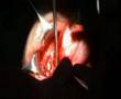 Excisão de tumor gigante da órbita por via anterior