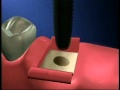 Implant Bridge Naples Dental Studio Naples Florida (239)262-4595