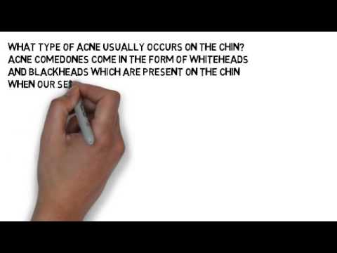 how to treat cystic acne on chin