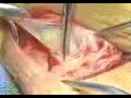 This video demonstrates the implantation procedure of the AMS 700 Penile Prosthesis.  American Medical Systems, Inc., 10700 Bren Rd. West, Minnetonka, MN 55343.