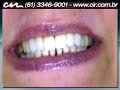 07 - Facetas em resina Cl�nica CIR (61) 3346-9001