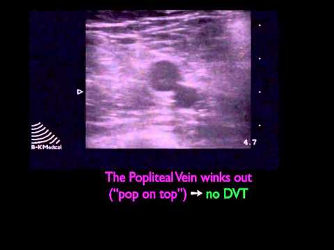 how to perform dvt ultrasound