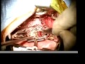 Transoral Odontoidectomy