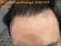BHR Clinic 3500 FUT Hair Line Repair BHR Clinic 3500 FUT Hair Line Repair