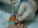 Deezys ingrown toenail