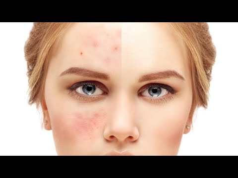 how to take zinc supplements for acne