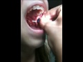 GNARLY TONSIL STONE REMOVAL!!!!