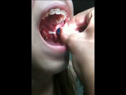 how to locate tonsils