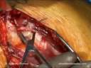 Univers II Techniques- Surgical Approach, Part 1. Univers II Techniques- Surgical Approach, Part 1.